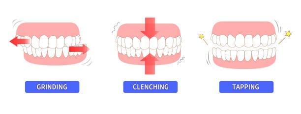 Understanding Bruxism: The Harmful Habit of Teeth Grinding and Clenching bruxism Understanding Bruxism: The Harmful Habit of Teeth Grinding and Clenching bruxism